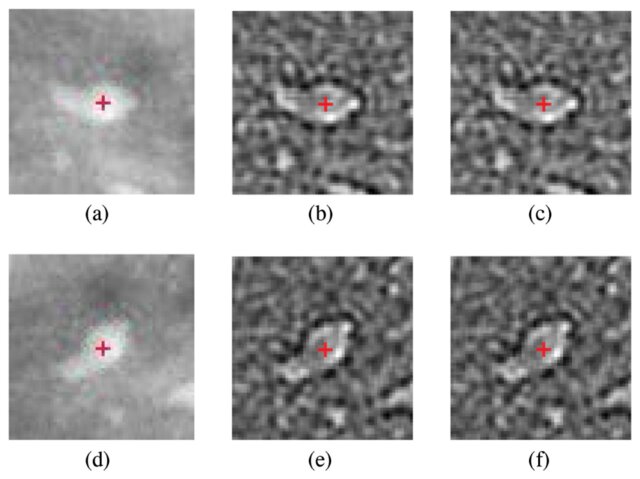 Figure from A Screening CAD Tool for the Detection of Microcalcification Clusters in Mammograms